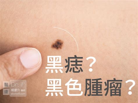 胸部長黑痣|不大驚小怪！如何辨別「黑痣」與「黑色腫瘤」？ 